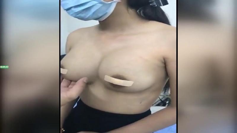 從鹹魚淘來的整容醫院偷拍視頻做完隆胸手術的妹子來醫院複查前後對比這醫生的手藝還真不錯